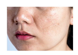 TRỊ NÁM PICOSURE